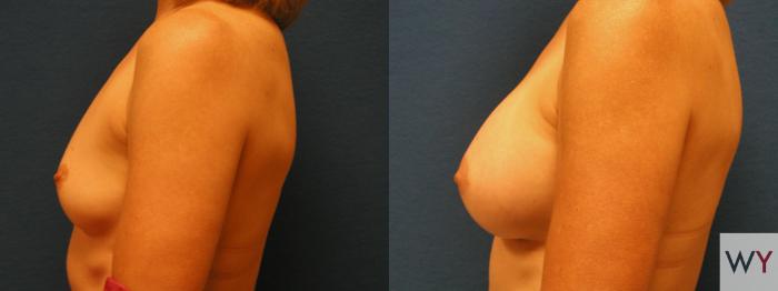 Before & After Breast Augmentation Case 83 View #2 View in Sacramento, Granite Bay, & Roseville, CA