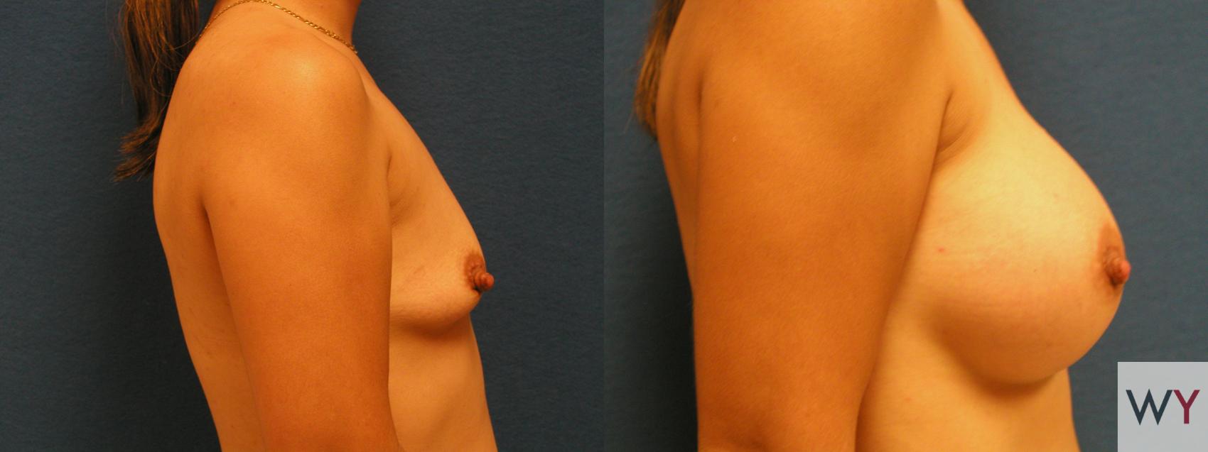 Before & After Breast Augmentation Case 84 View #2 View in Sacramento, CA