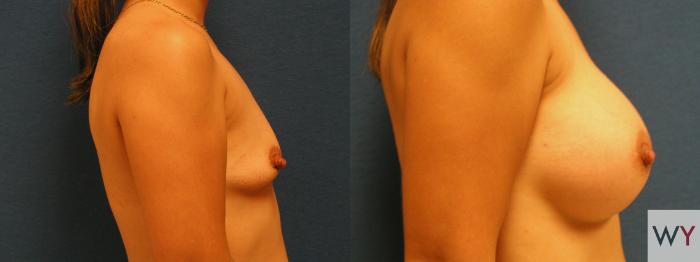 Before & After Breast Augmentation Case 84 View #2 View in Sacramento, Granite Bay, & Roseville, CA