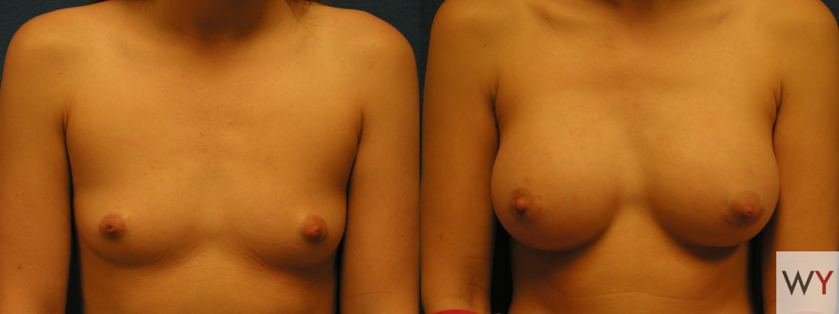 Before & After Breast Augmentation Case 85 View #1 View in Sacramento, CA
