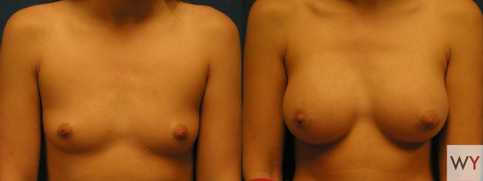 Before & After Breast Augmentation Case 85 View #1 View in Sacramento, Granite Bay, & Roseville, CA