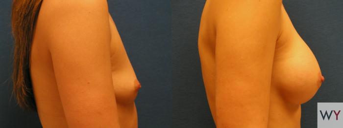 Before & After Breast Augmentation Case 85 View #2 View in Sacramento, Granite Bay, & Roseville, CA