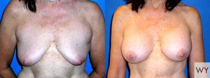 Before & After Breast Augmentation Case 86 View #1 View in Sacramento, Granite Bay, & Roseville, CA