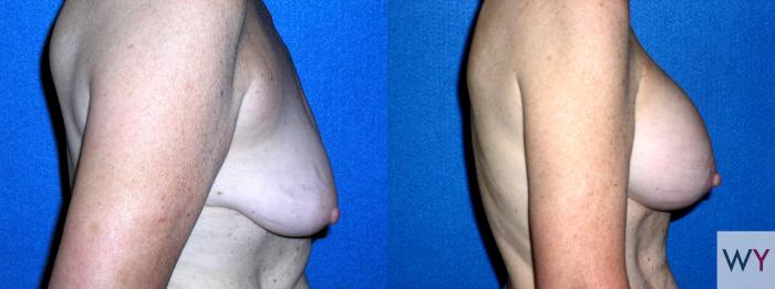 Before & After Breast Augmentation Case 86 View #2 View in Sacramento, Granite Bay, & Roseville, CA