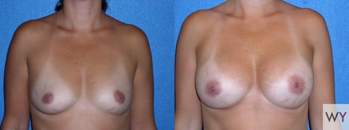Before & After Breast Augmentation Case 87 View #1 View in Sacramento, Granite Bay, & Roseville, CA