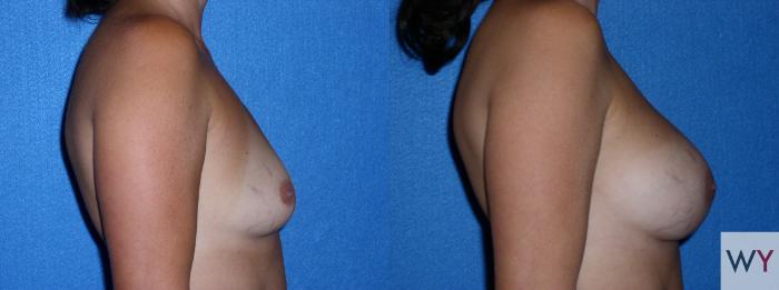 Before & After Breast Augmentation Case 87 View #2 View in Sacramento, Granite Bay, & Roseville, CA