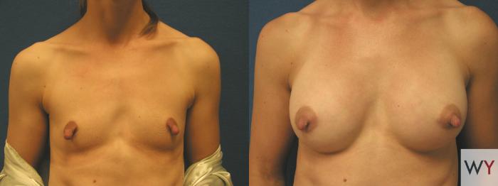 Before & After Breast Augmentation Case 88 View #1 View in Sacramento, Granite Bay, & Roseville, CA