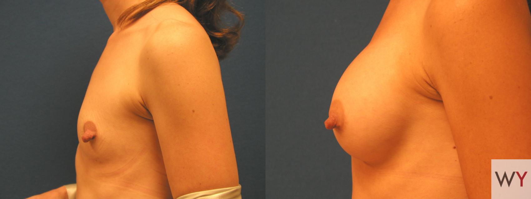 Before & After Breast Augmentation Case 88 View #2 View in Sacramento, CA
