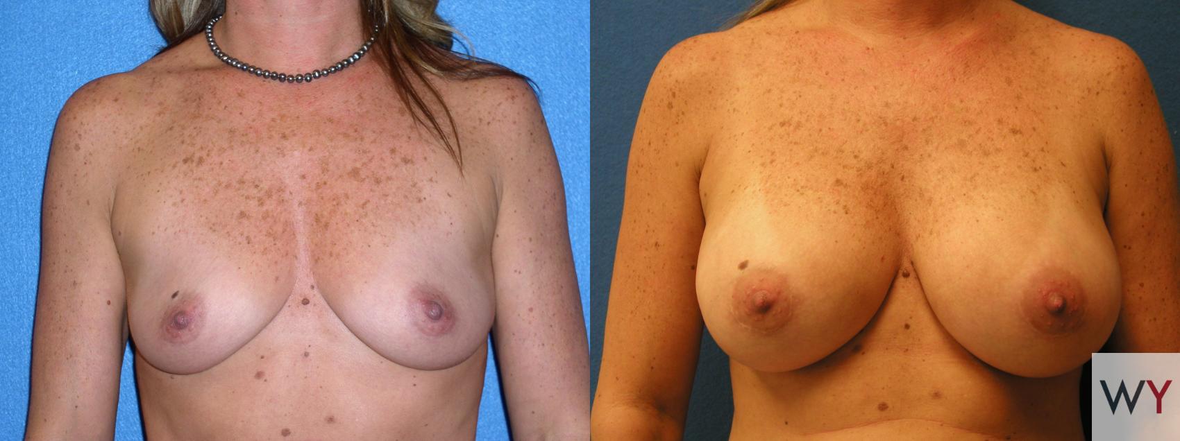 Before & After Breast Augmentation Case 89 View #1 View in Sacramento, CA