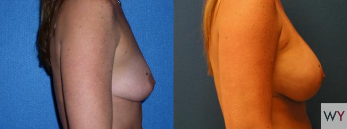 Before & After Breast Augmentation Case 89 View #2 View in Sacramento, CA