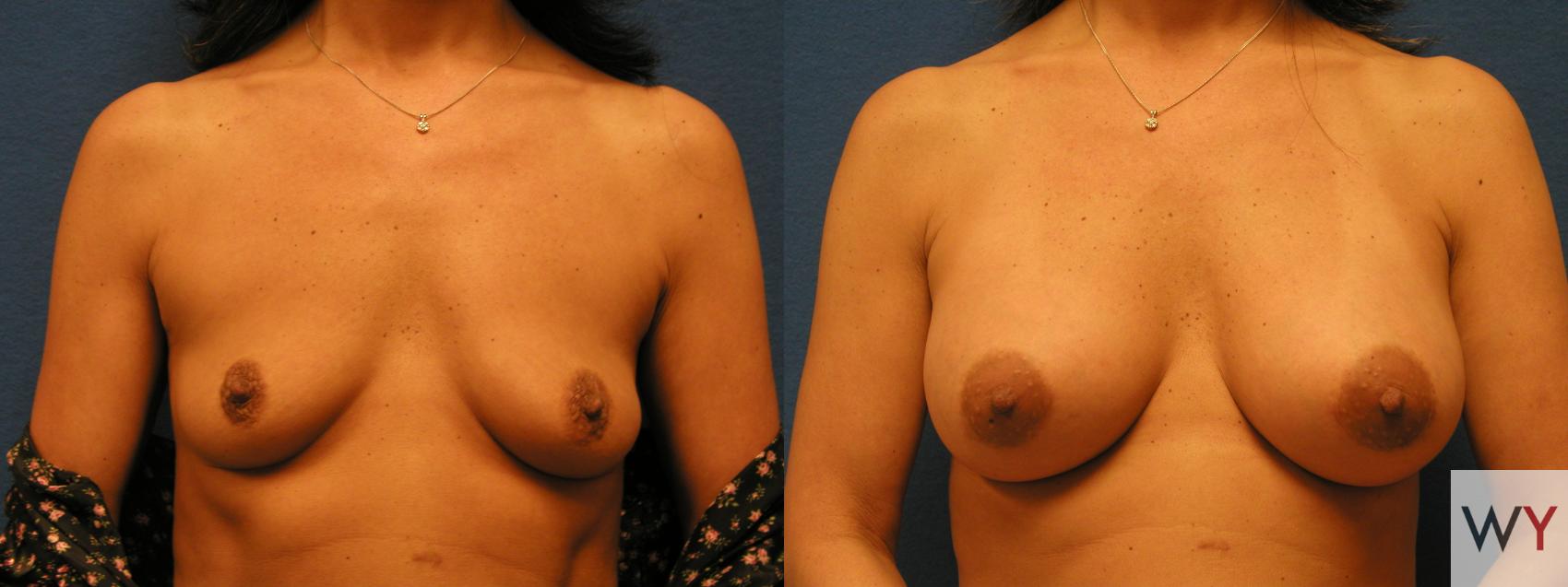 Before & After Breast Augmentation Case 99 View #1 View in Sacramento, Granite Bay, & Roseville, CA