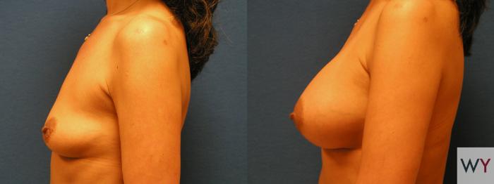 Before & After Breast Augmentation Case 99 View #2 View in Sacramento, Granite Bay, & Roseville, CA