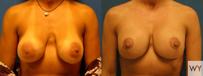 Before & After Breast Lift Case 127 View #1 View in Sacramento, Granite Bay, & Roseville, CA
