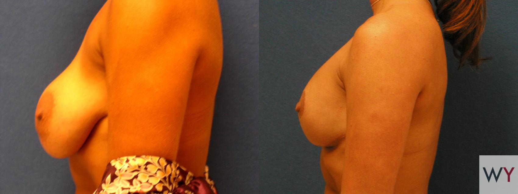 Before & After Breast Lift Case 127 View #2 View in Sacramento, CA