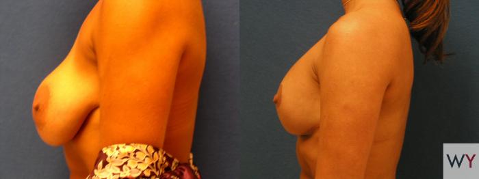 Before & After Breast Lift Case 127 View #2 View in Sacramento, Granite Bay, & Roseville, CA
