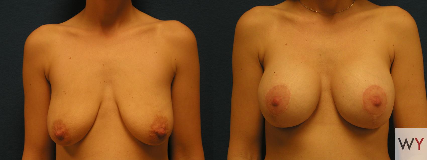 Before & After Breast Lift Case 131 View #1 View in Sacramento, CA
