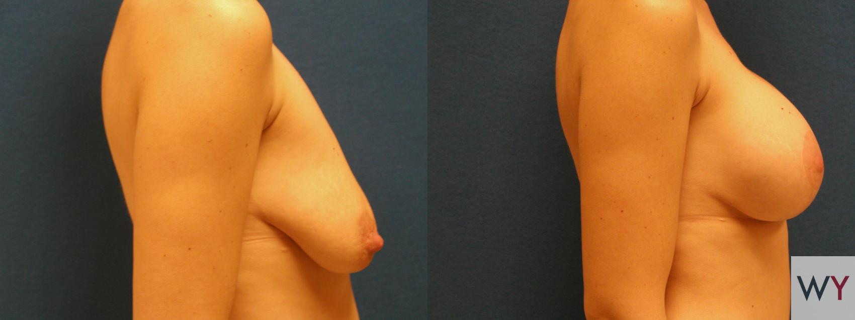 Before & After Breast Lift Case 131 View #2 View in Sacramento, CA