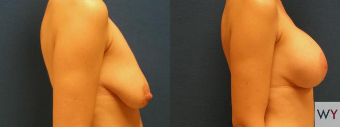 Before & After Breast Lift Case 131 View #2 View in Sacramento, Granite Bay, & Roseville, CA