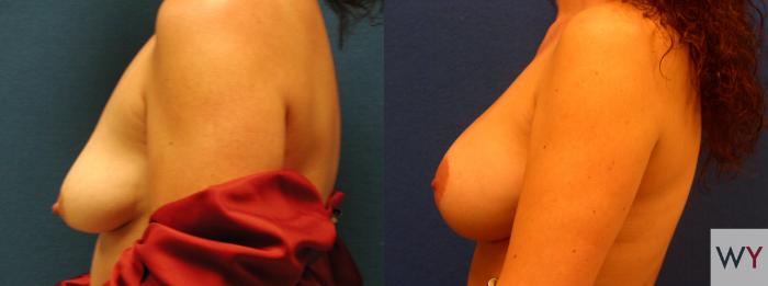 Before & After Breast Lift Case 139 View #2 View in Sacramento, Granite Bay, & Roseville, CA