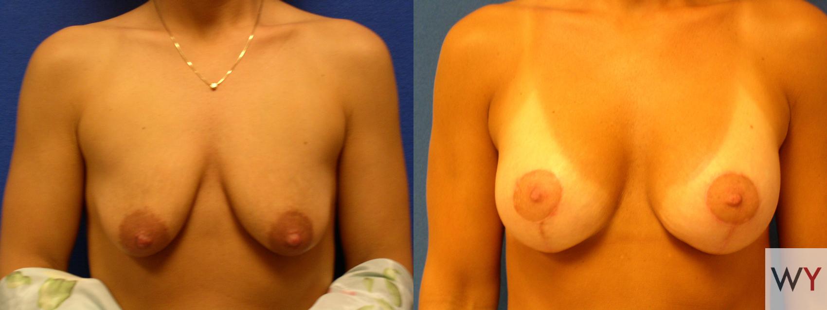 Before & After Breast Lift Case 75 View #1 View in Sacramento, Granite Bay, & Roseville, CA