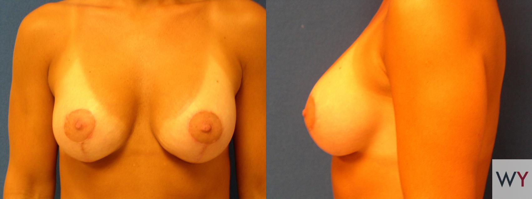 Before & After Breast Lift Case 75 View #2 View in Sacramento, CA