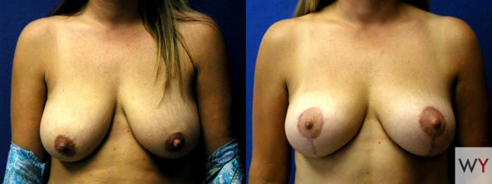 Before & After Breast Lift Case 92 View #1 View in Sacramento, Granite Bay, & Roseville, CA