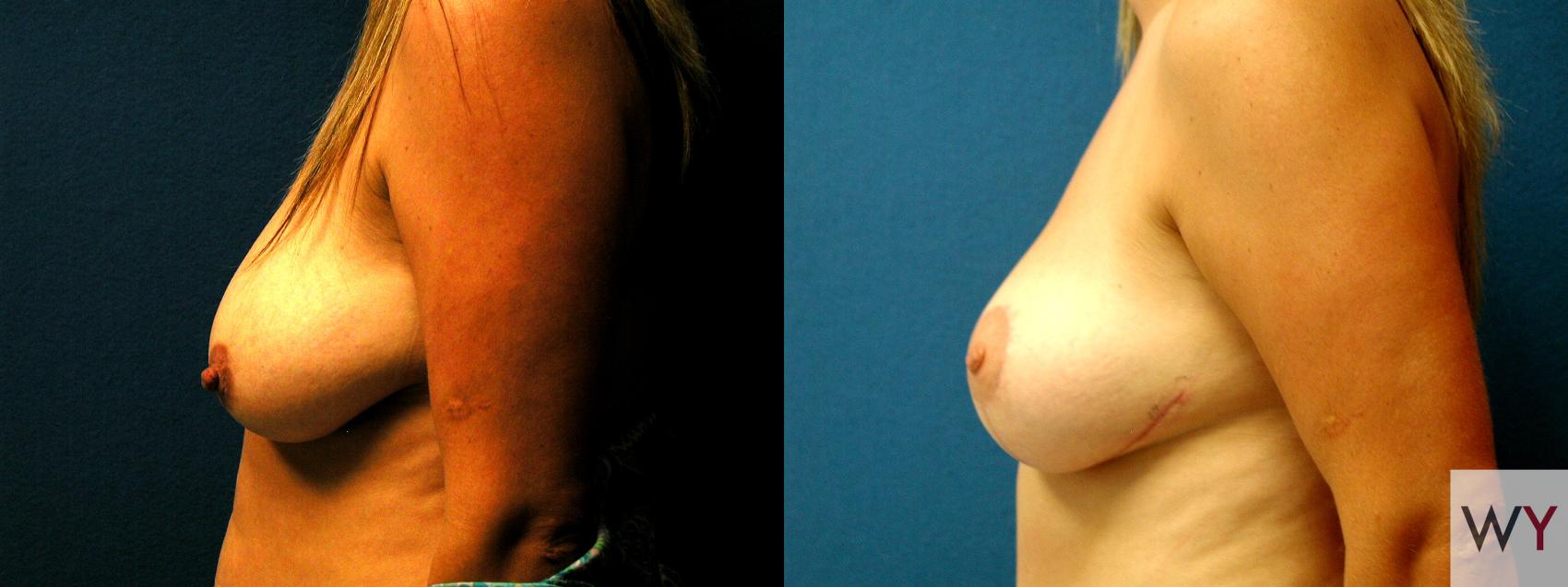 Before & After Breast Lift Case 92 View #2 View in Sacramento, Granite Bay, & Roseville, CA