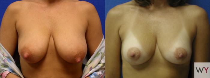 Before & After Breast Lift Case 96 View #1 View in Sacramento, Granite Bay, & Roseville, CA