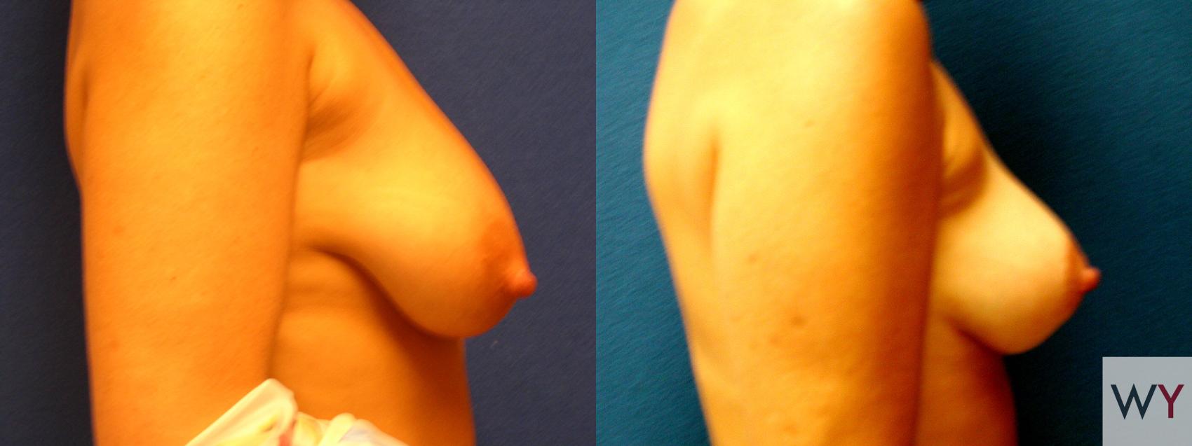 Before & After Breast Lift Case 96 View #2 View in Sacramento, CA