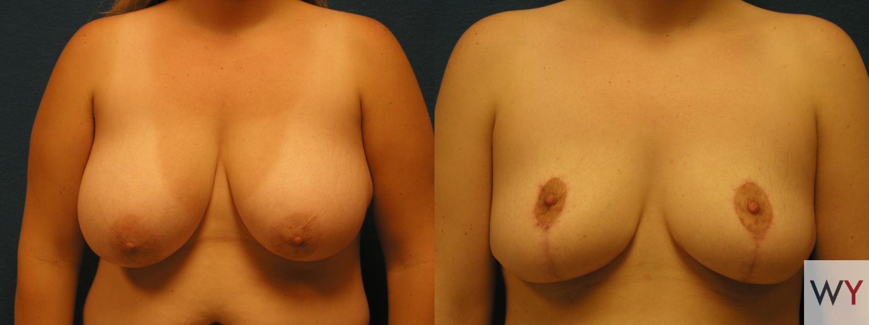 Before & After Breast Reduction Case 108 View #1 View in Sacramento, Granite Bay, & Roseville, CA