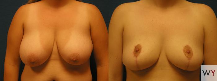 Before & After Breast Reduction Case 108 View #1 View in Sacramento, CA