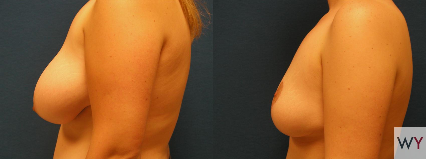 Before & After Breast Reduction Case 108 View #2 View in Sacramento, CA