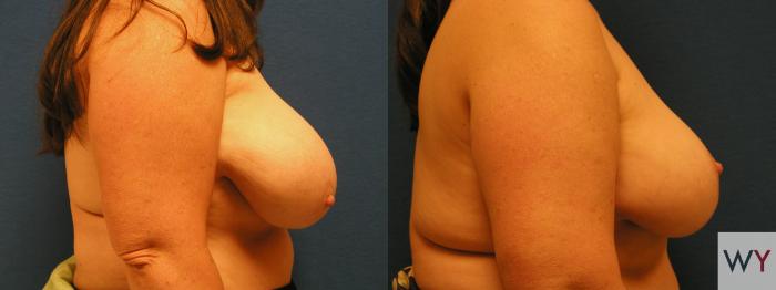 Before & After Breast Reduction Case 132 View #2 View in Sacramento, Granite Bay, & Roseville, CA
