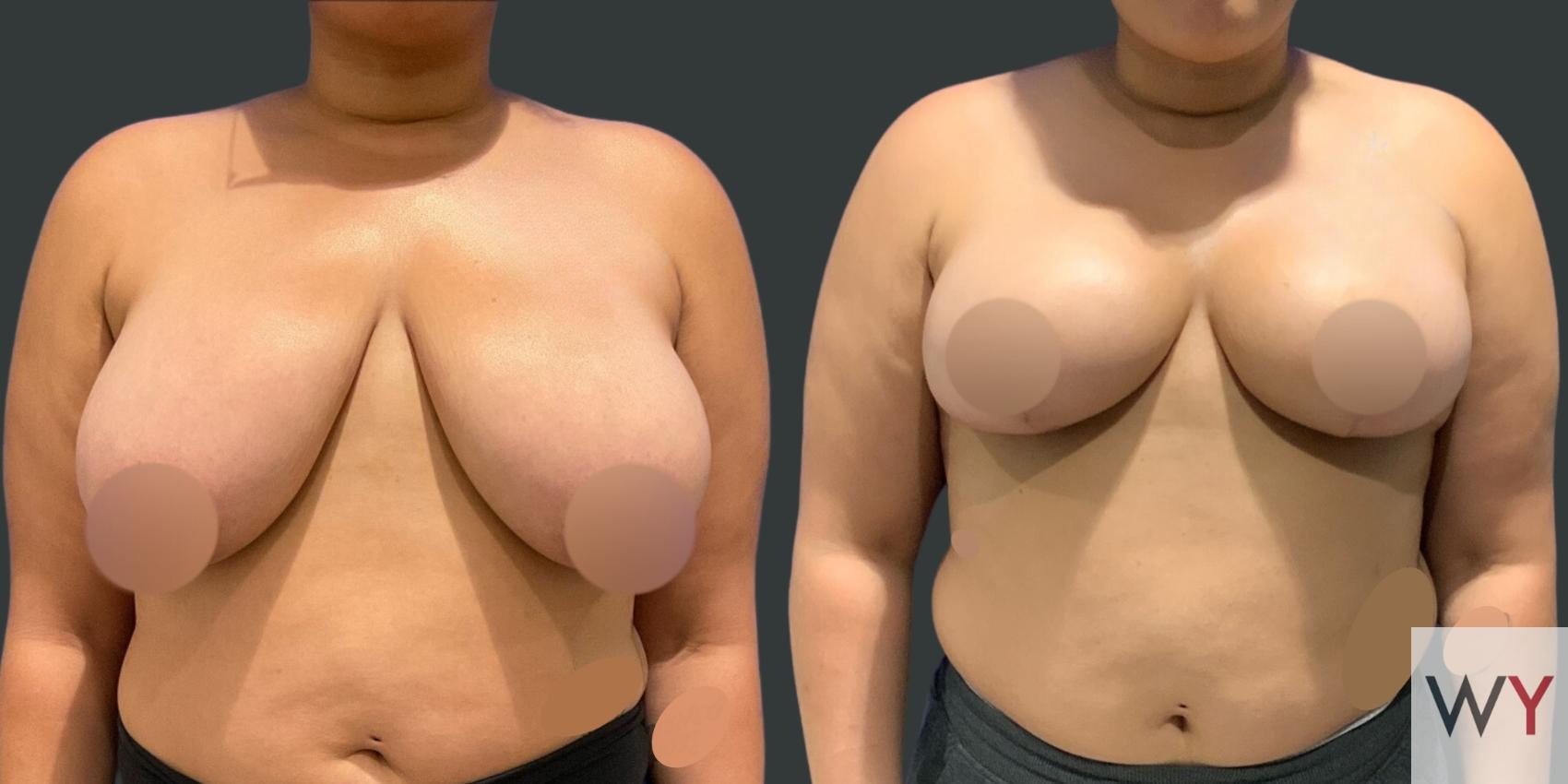 Breast Reduction