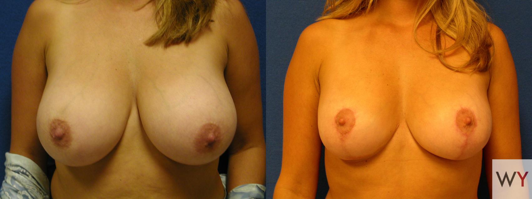 Before & After Breast Reduction Case 93 View #1 View in Sacramento, Granite Bay, & Roseville, CA