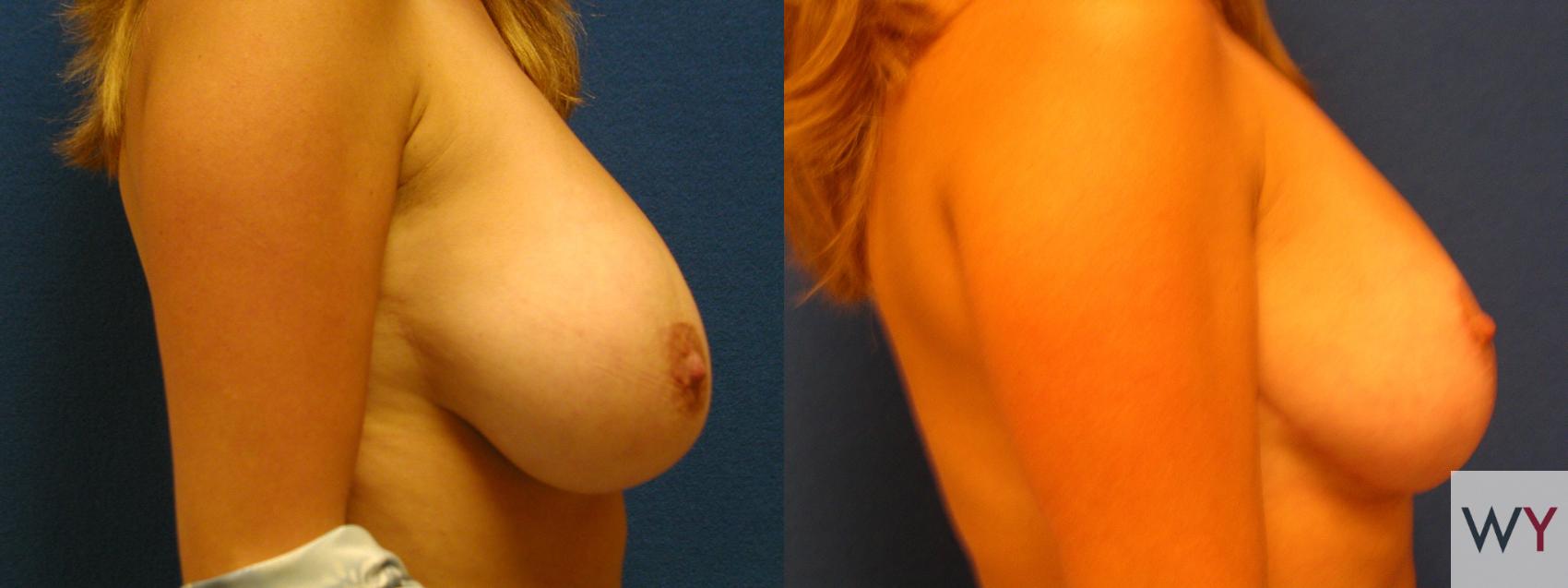 Before & After Breast Reduction Case 93 View #2 View in Sacramento, CA