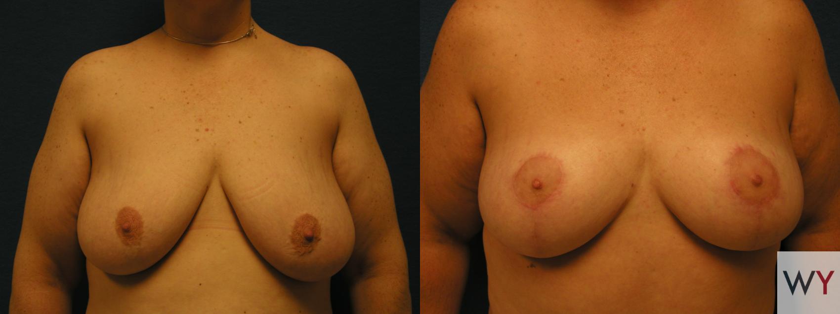 Before & After Breast Reduction Case 94 View #1 View in Sacramento, Granite Bay, & Roseville, CA