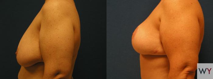 Before & After Breast Reduction Case 94 View #2 View in Sacramento, Granite Bay, & Roseville, CA