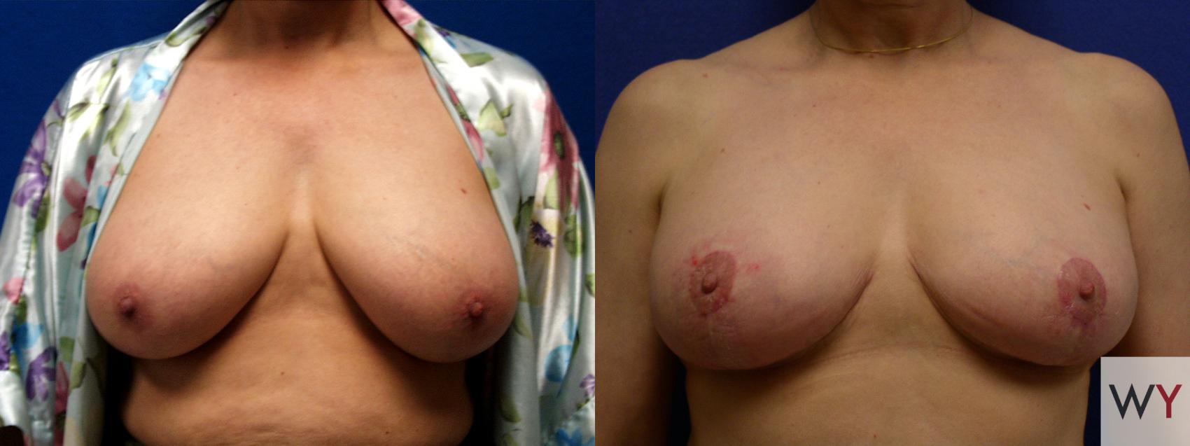 Before & After Breast Reduction Case 95 View #1 View in Sacramento, Granite Bay, & Roseville, CA