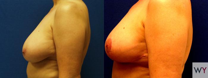 Before & After Breast Reduction Case 95 View #2 View in Sacramento, CA