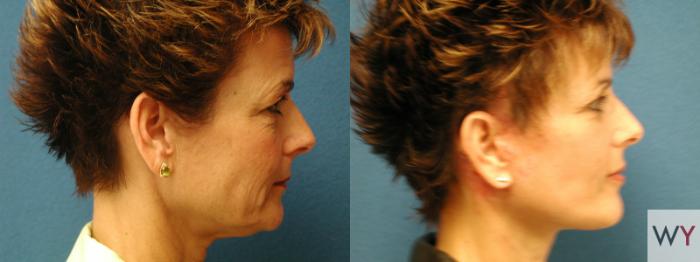 Before & After Facelift Case 78 View #2 View in Sacramento, Granite Bay, & Roseville, CA