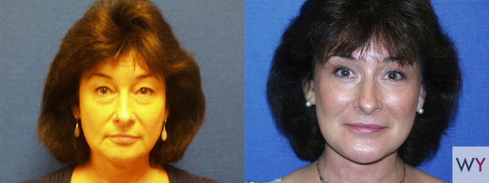 Before & After Facelift Case 79 View #1 View in Sacramento, Granite Bay, & Roseville, CA