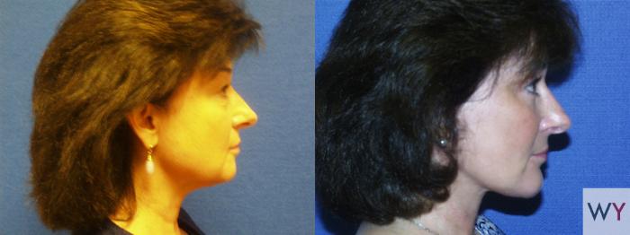 Before & After Facelift Case 79 View #2 View in Sacramento, Granite Bay, & Roseville, CA