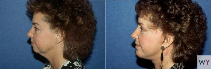 Before & After Facelift Case 80 View #2 View in Sacramento, Granite Bay, & Roseville, CA