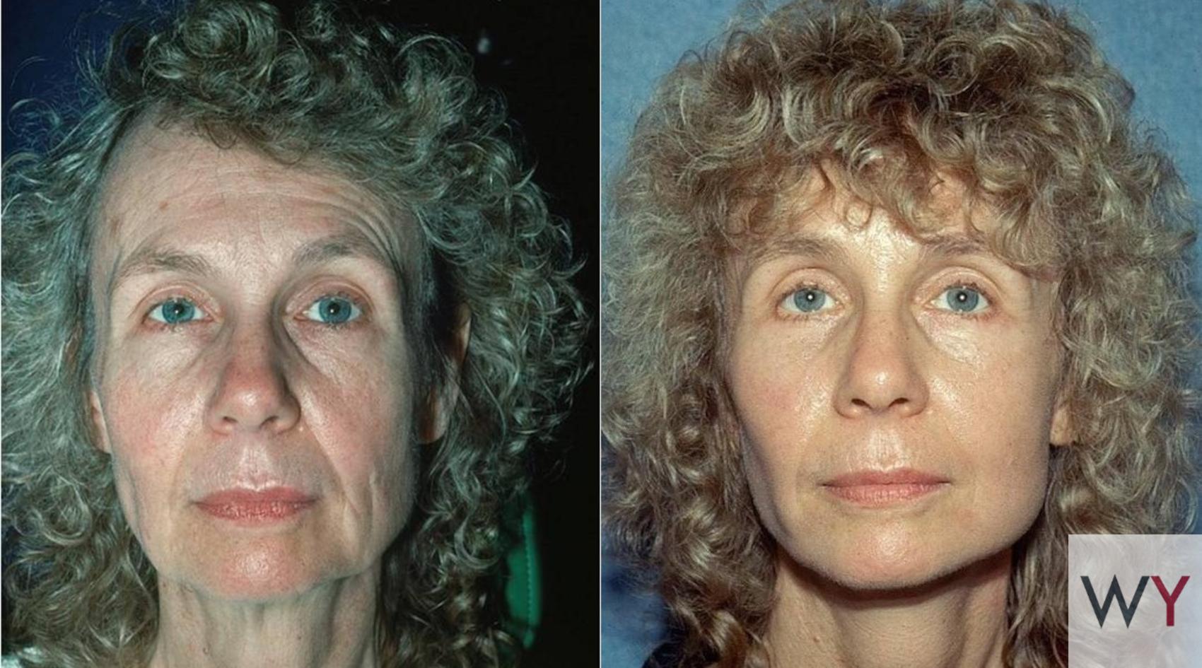 Before & After Facelift Case 82 View #1 View in Sacramento, Granite Bay, & Roseville, CA