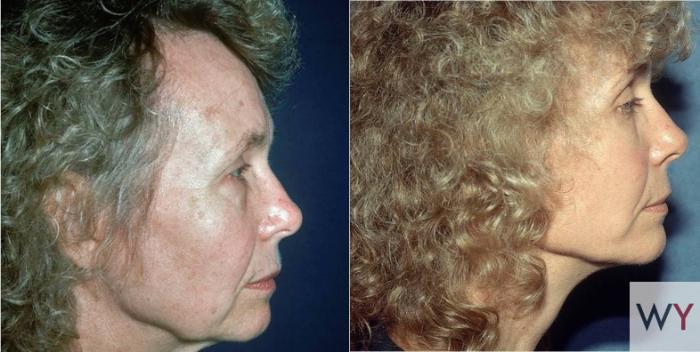 Before & After Facelift Case 82 View #2 View in Sacramento, Granite Bay, & Roseville, CA