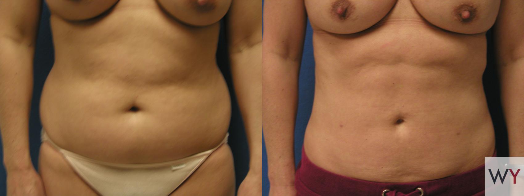 Before & After Liposuction Case 90 View #1 View in Sacramento, Granite Bay, & Roseville, CA