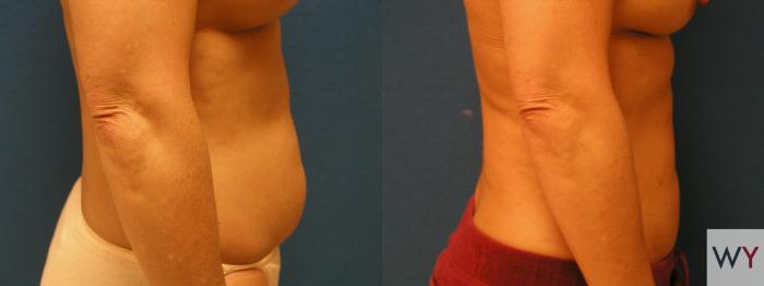Before & After Liposuction Case 90 View #2 View in Sacramento, Granite Bay, & Roseville, CA