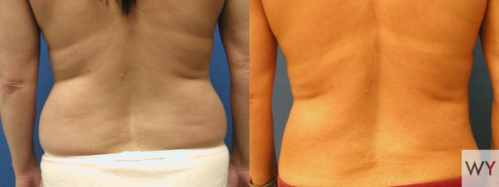 Before & After Liposuction Case 90 View #3 View in Sacramento, Granite Bay, & Roseville, CA