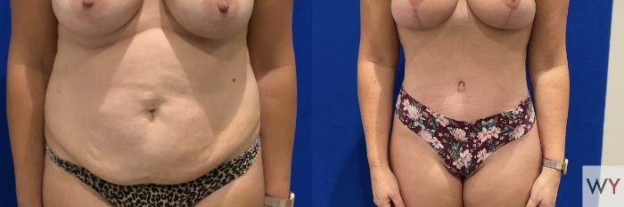 Before & After Mommy Makeover Case 143 Front Abdomen View in Sacramento, Granite Bay, & Roseville, CA